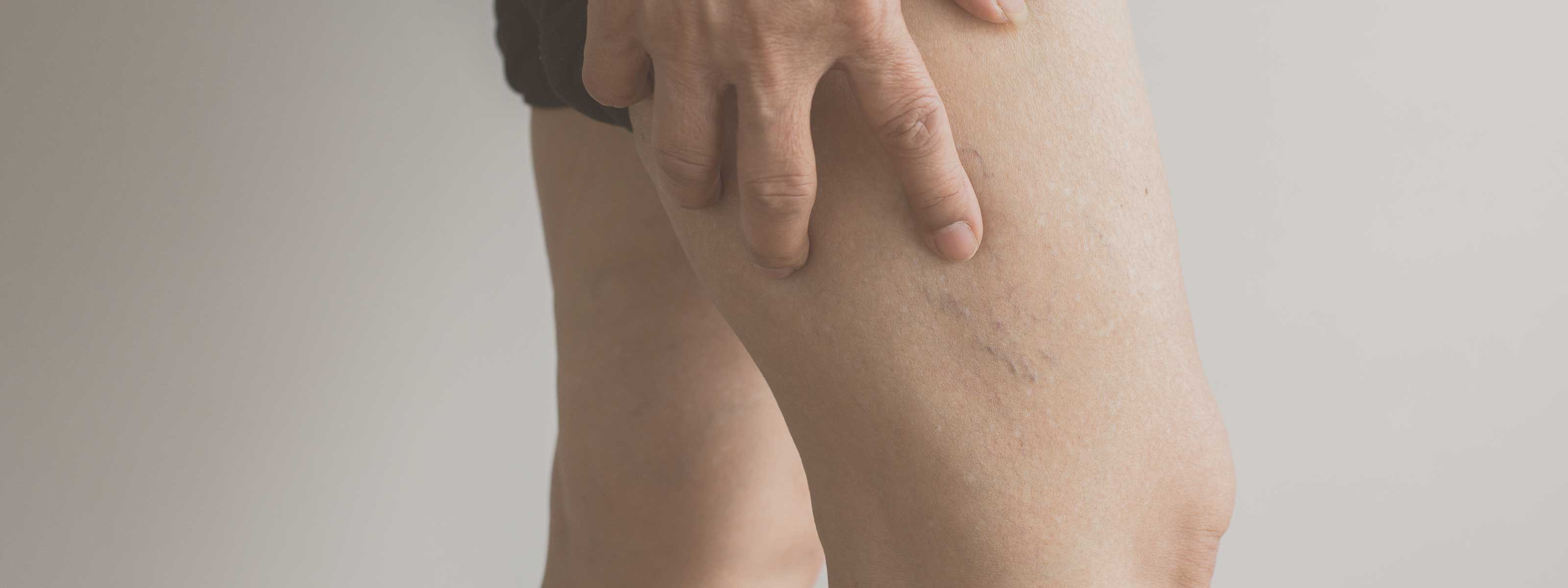 scopri i prodotti naturali per trattare la fragilità capillare