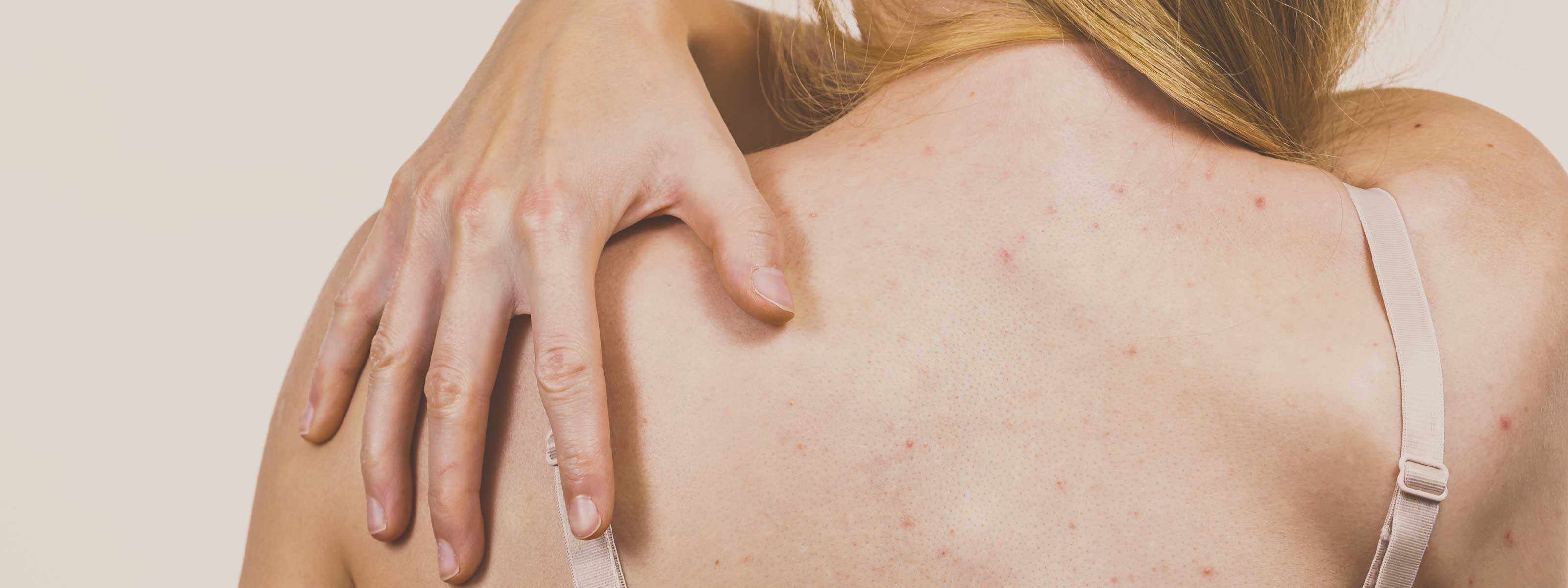 rimedi per l'acne della schiena 